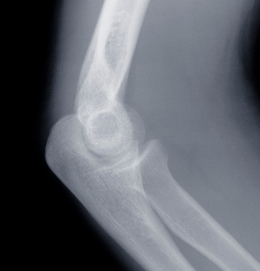 Elbow Conditions
