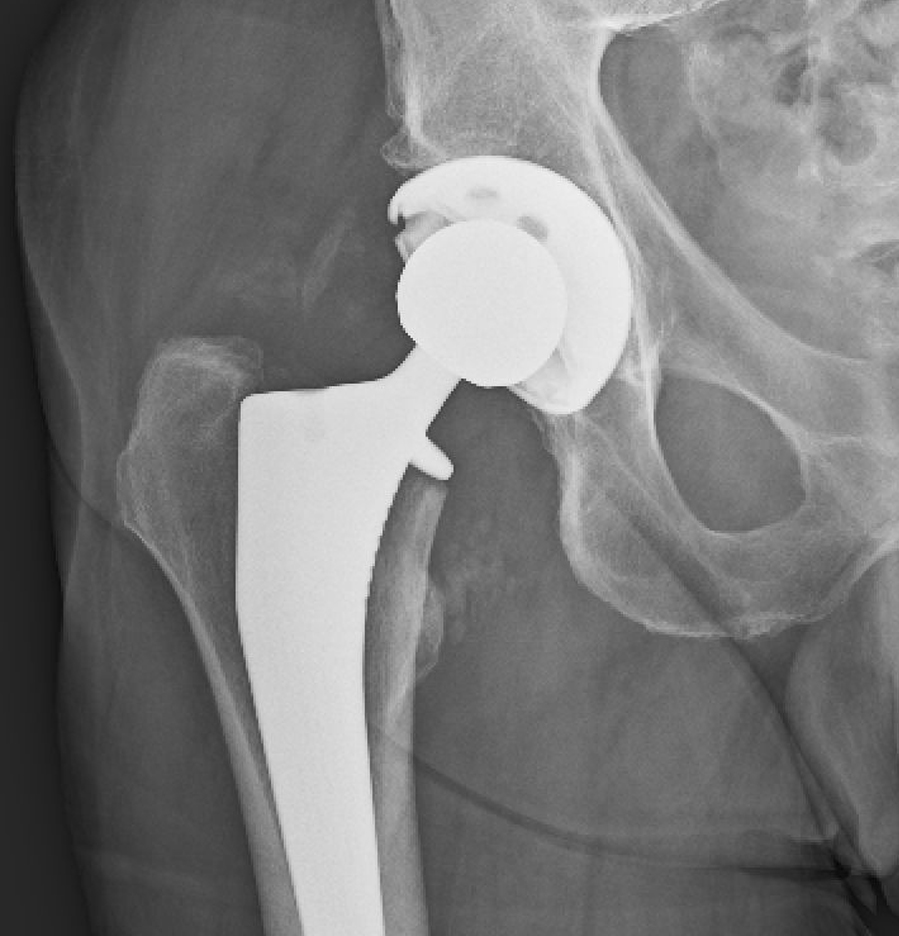 Hip Conditions