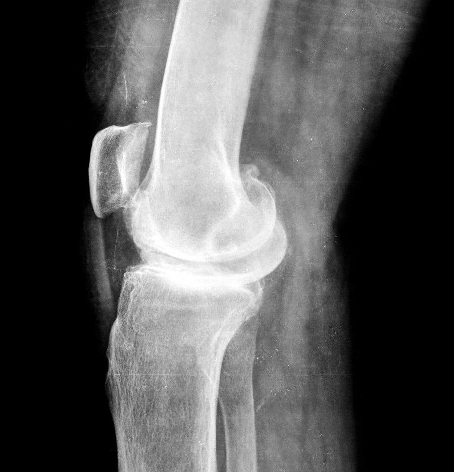 Knee Conditions