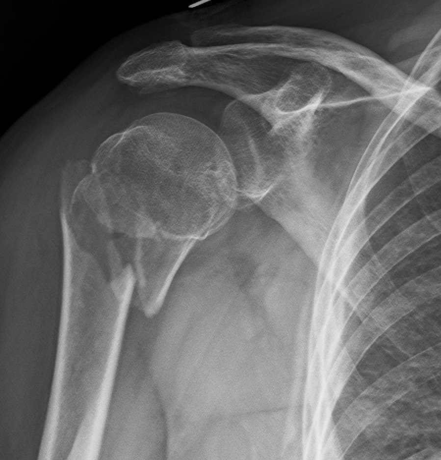 Shoulder Conditions